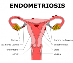 PROYECCIÓN DOCUMENTAL: ENDOMETRIOSIS